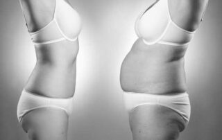liposuction types