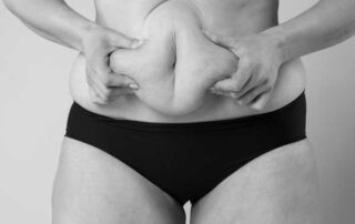 preparing for liposuction