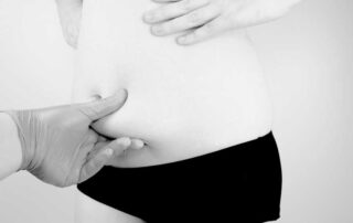 Abdominoplasty with Liposuction