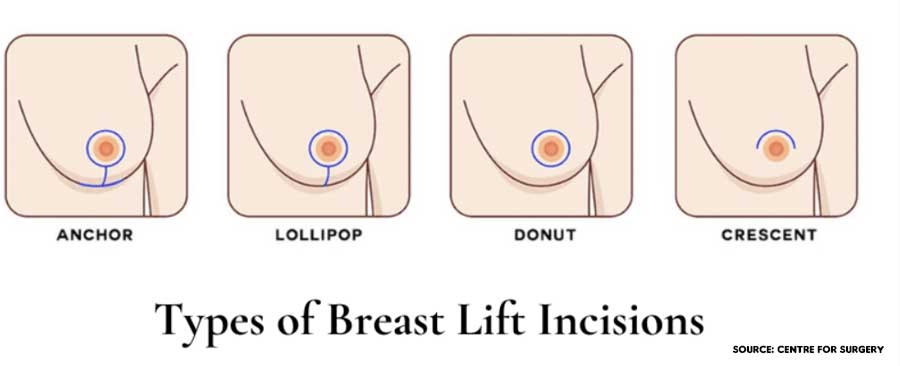 breast lift types