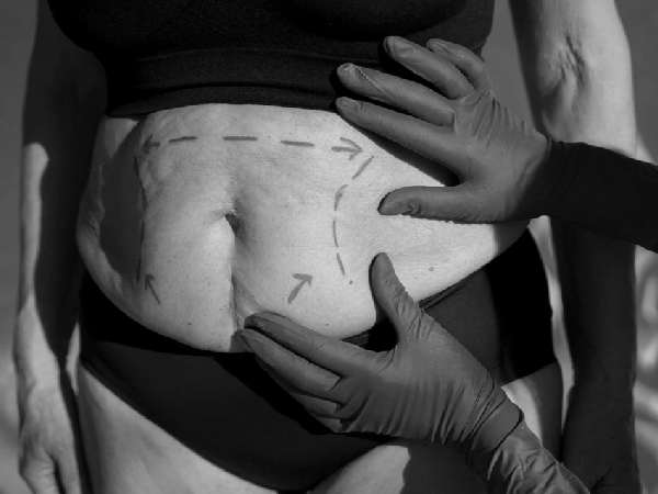 Abdominoplasty in Richmond Hill