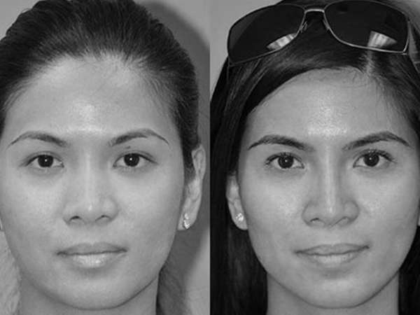 Liquid Rhinoplasty
