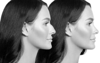 Rhinoplasty for Wide Nose