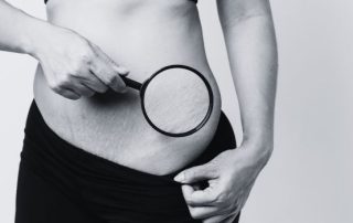 How to Remove Stretch Marks on Stomach: Effective Treatments & Realistic Expectations