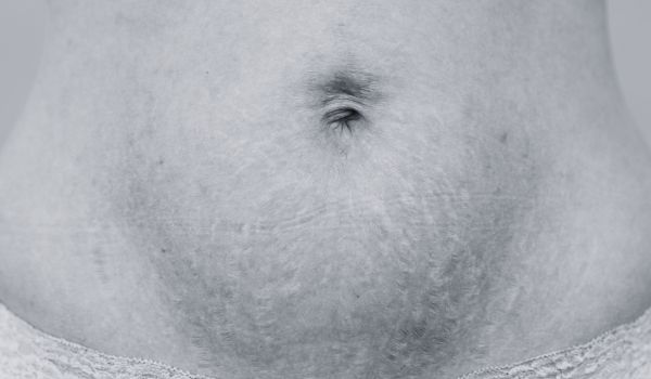 How to Reduce Stretch Marks on the Stomach at Home