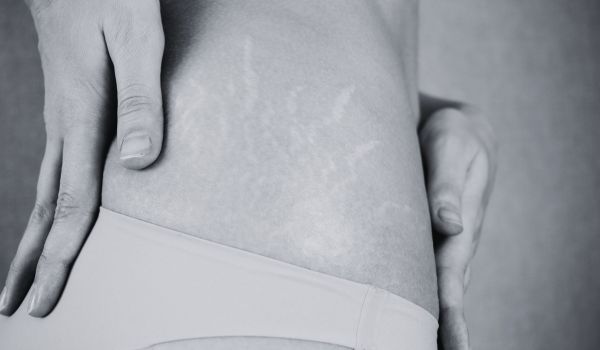Does Plastic Surgery Help with Stubborn Stretch Marks?