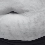 Introduction: The Growing Demand for Non-Surgical Weight Loss in Canada