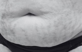 Introduction: The Growing Demand for Non-Surgical Weight Loss in Canada