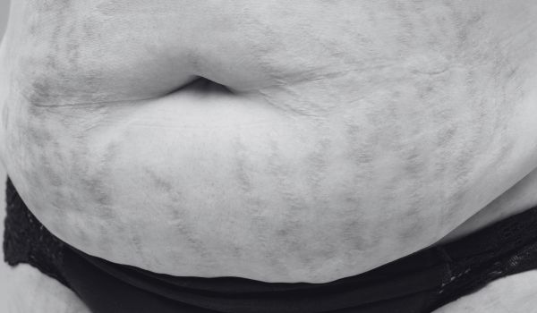 Introduction: The Growing Demand for Non-Surgical Weight Loss in Canada